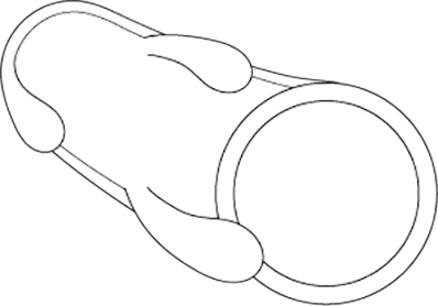 Barbed Suture